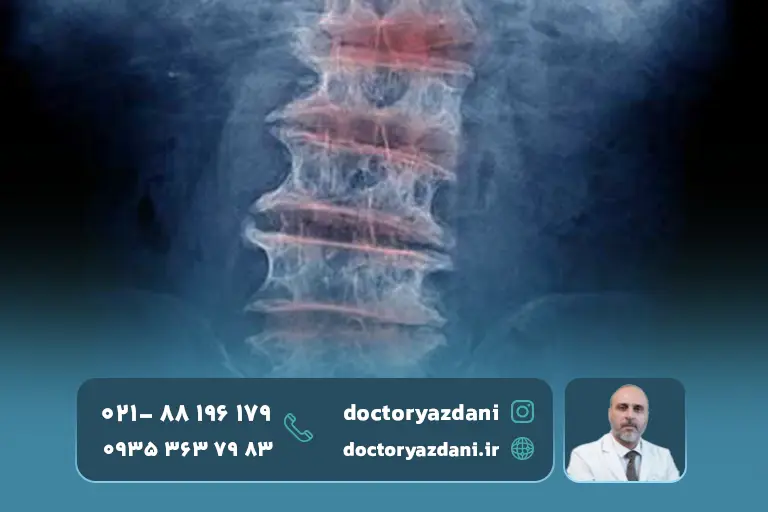 عکس ستون فقرات دارای مشکل و درد